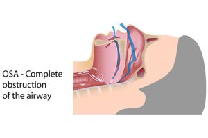 โรคหยุดหายใจขณะหลับจากการอุดกั้น (OBSTRUCTIVE SLEEP APNEA: OSA) กับการผ่าตัด