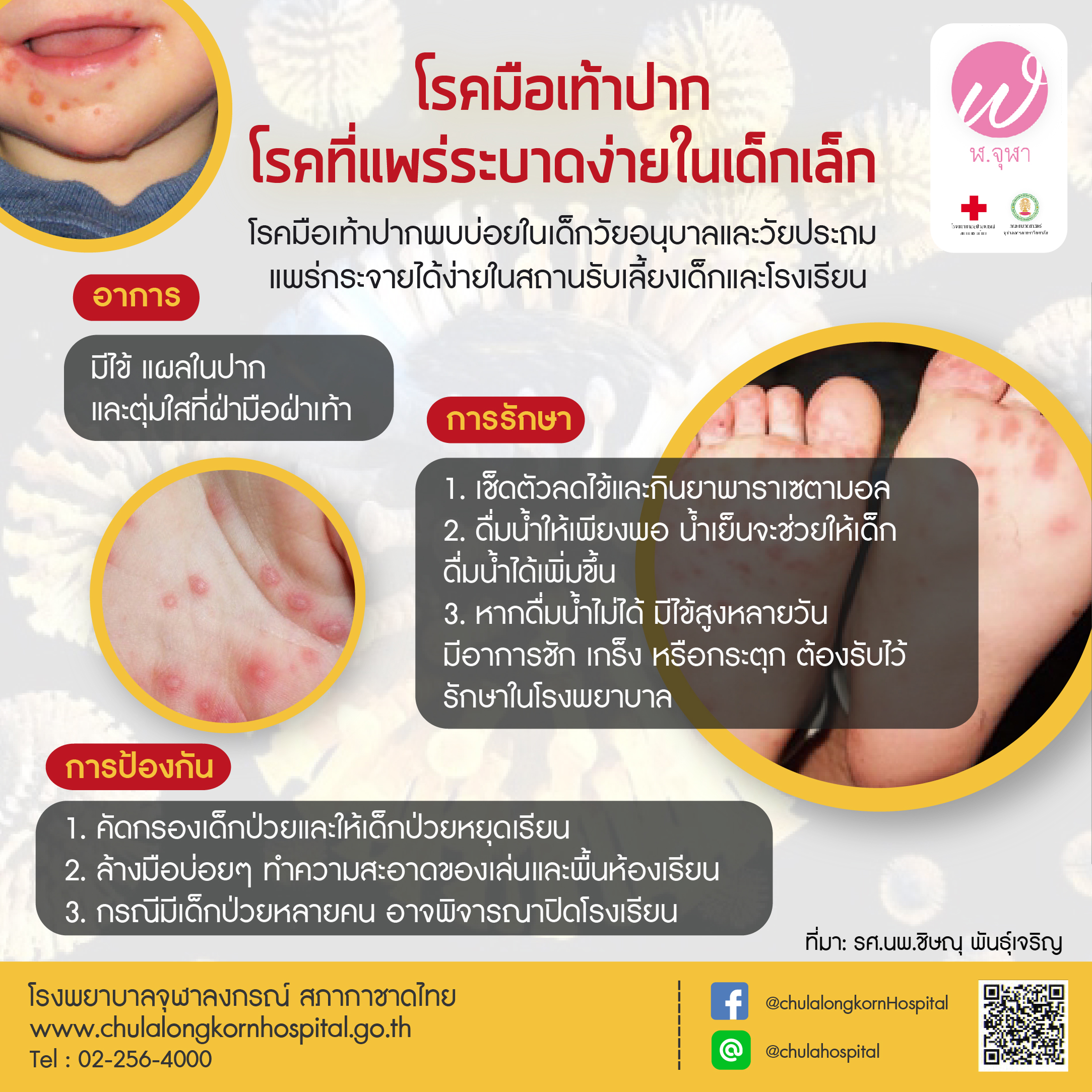 โรคมือเท้าปาก โรคที่แพร่ระบาดง่ายในเด็กเล็ก