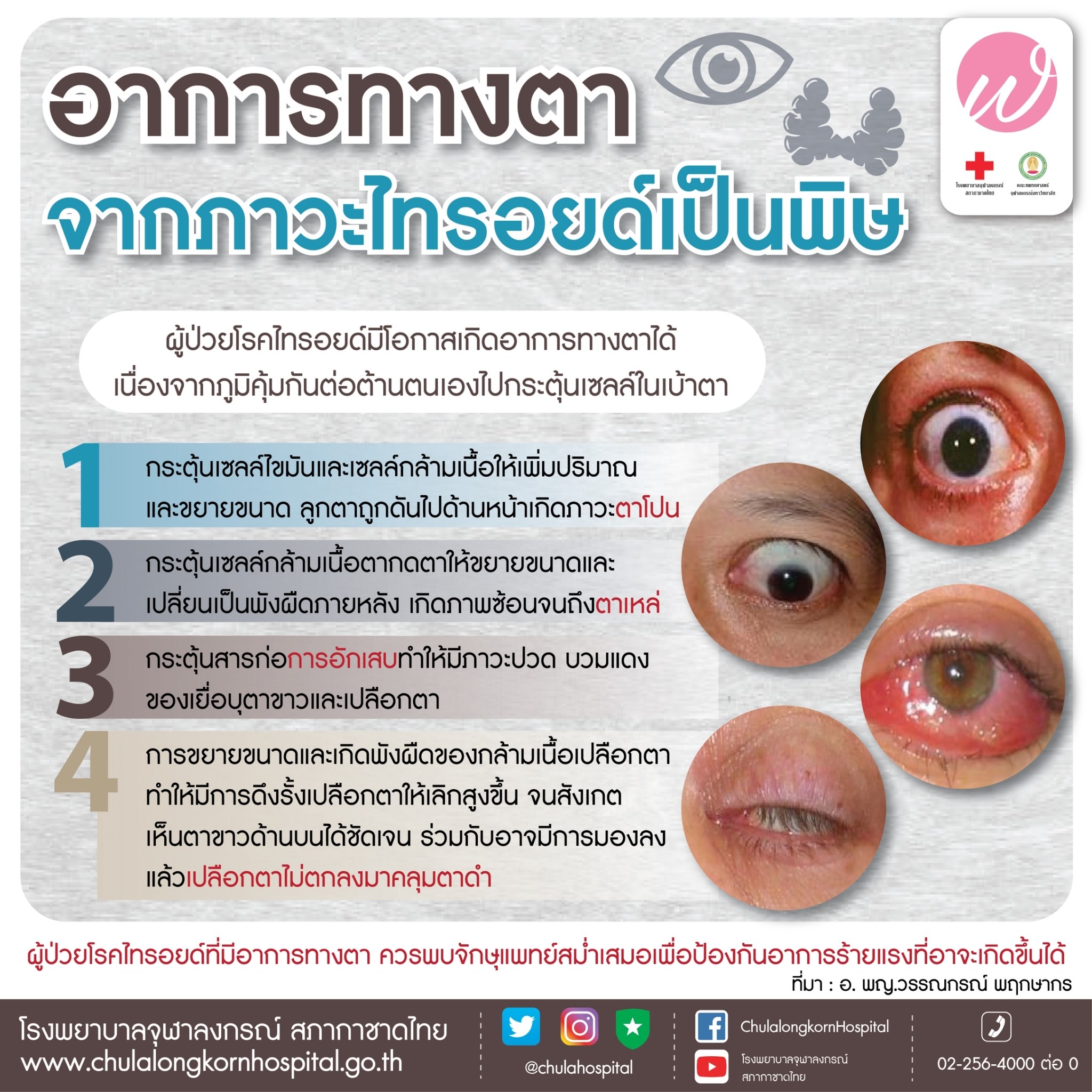 อาการทางตา จากภาวะไทรอยด์เป็นพิษ