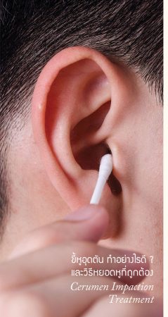 ขี้หูอุตตันทำอย่างไรดี? และวิธีหยอดหูที่ถูกต้อง